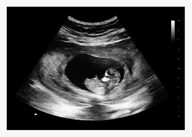 8 Weeks Alternate Fake Ultrasound