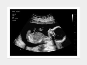 20 Weeks Fake Ultrasound Image