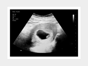 6 weeks ultrasound image