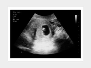 6 weeks ultrasound image