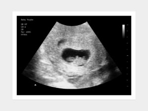 7 weeks ultrasound image