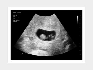 7 weeks ultrasound image